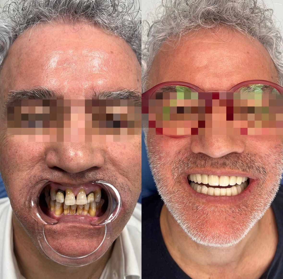 impianti dentali